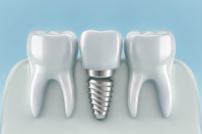 Why Dental Implants Are Worth the Investment - Luna Dental