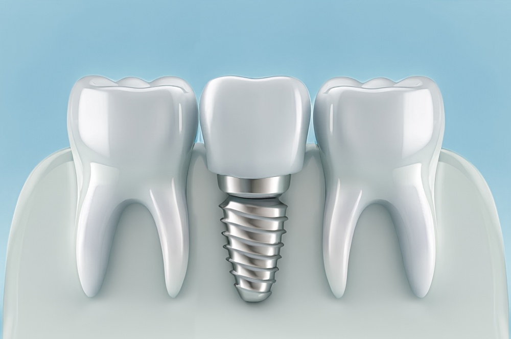 Dental Implants Are Worth the Investment