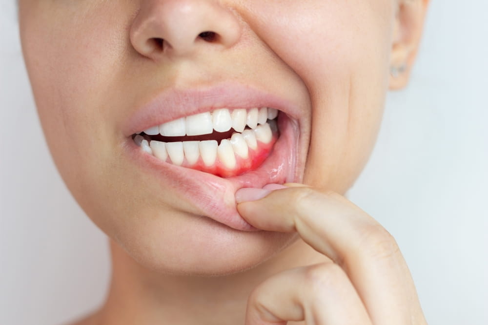 What Are the Symptoms of Gum Disease and When Should You See a Dentist
